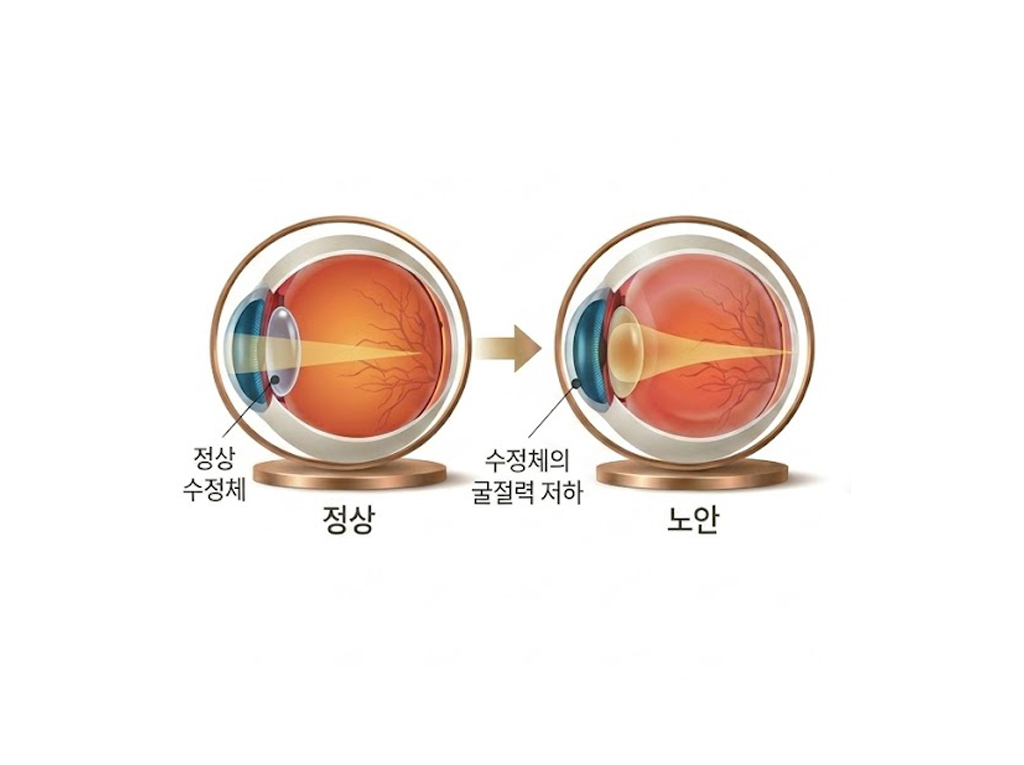 노안 백내장 상세 이미지
